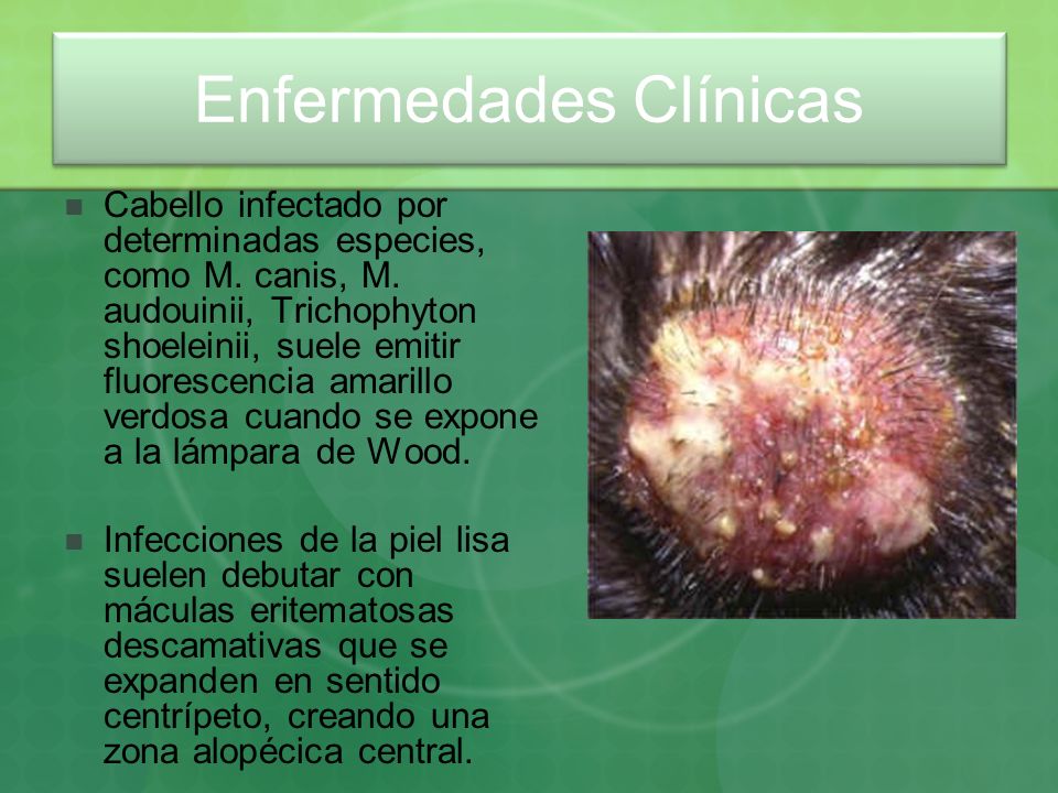 El medio homeopático a los hongos sobre las uñas
